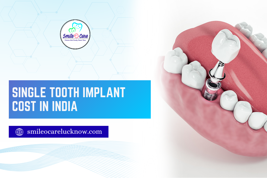 Single Tooth Implant Cost in India